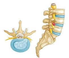 Prolapsed Disc Treatment in Delhi